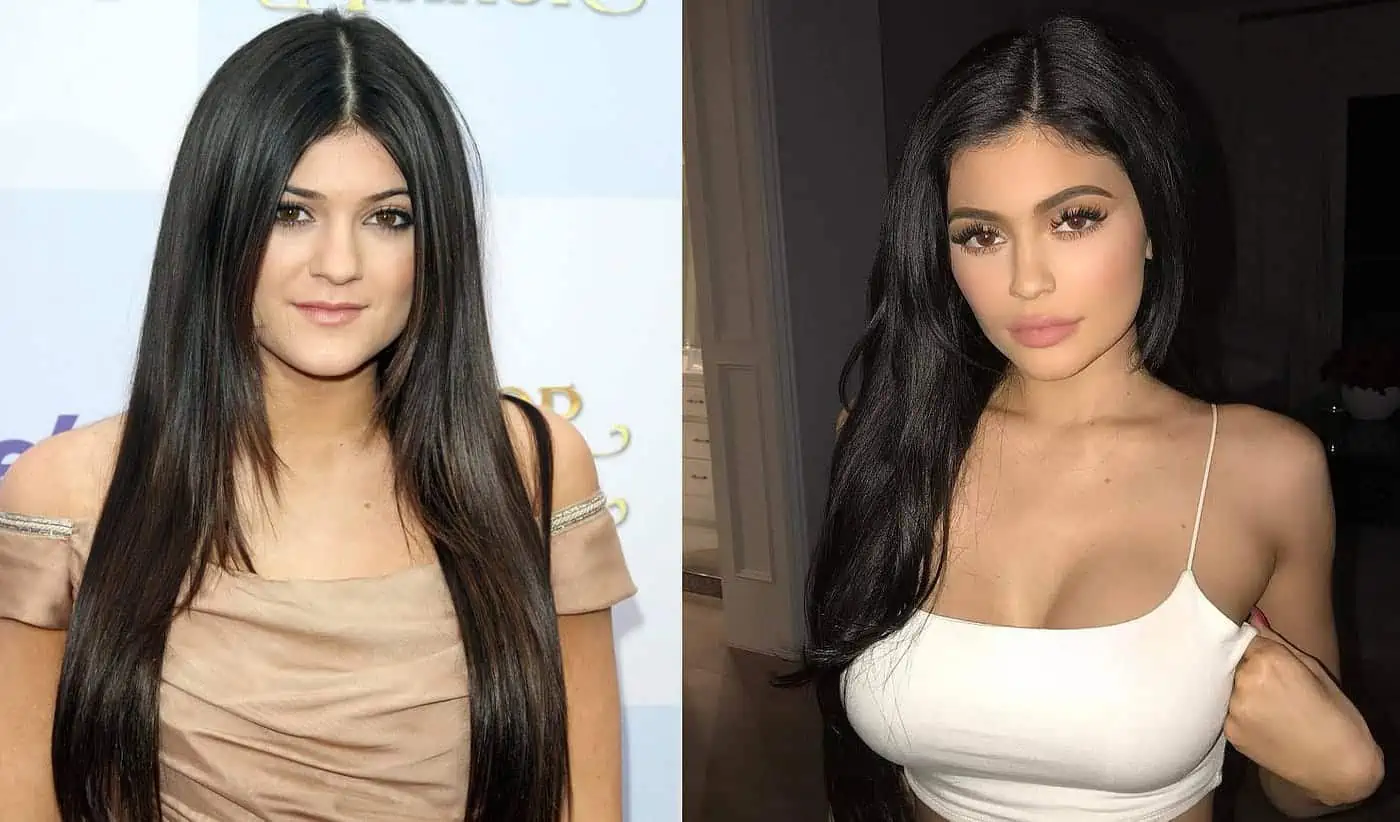 Kylie Jenner Discusses Plastic Surgery